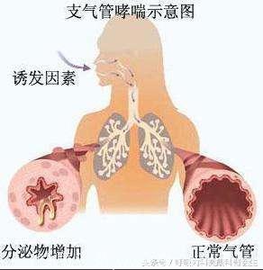 哮喘的分类形式有哪些，不同分类形式中有哪些哮喘类型？