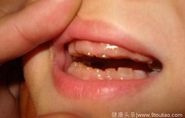 五岁儿童牙齿腐烂，甚至说话不清楚，是什么导致的？