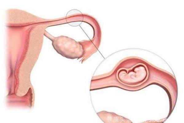 宫外孕前期有什么反应？怀孕后的这4个症状，就是在提醒你！