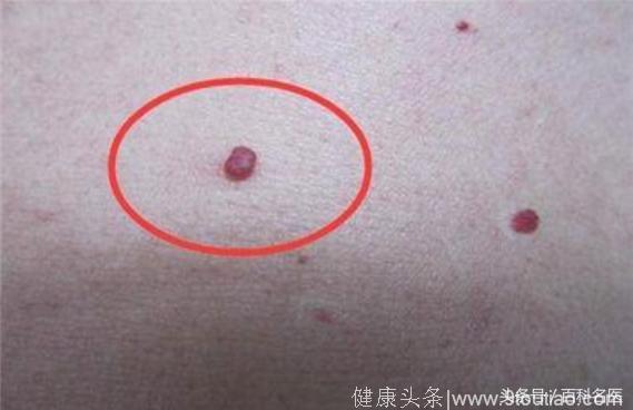 皮肤上长这种“红点儿”是肝硬化、脂肪肝、肝功能障碍的信号！