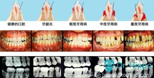 如何预防口腔慢性病——牙周病？