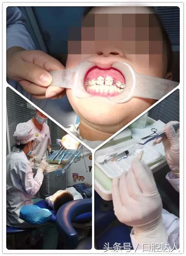儿牙医生争分夺秒挽就小朋友脱落的门牙——牙掉了这样做还有救！