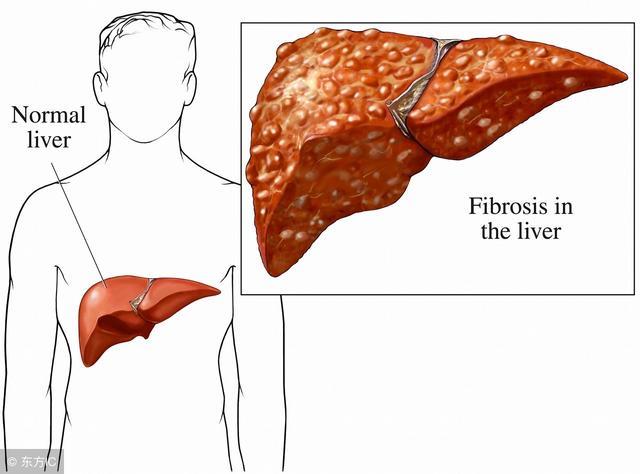肝硬化居然这么“厉害”，养肝护肝，早做一天离肝硬化晚一点