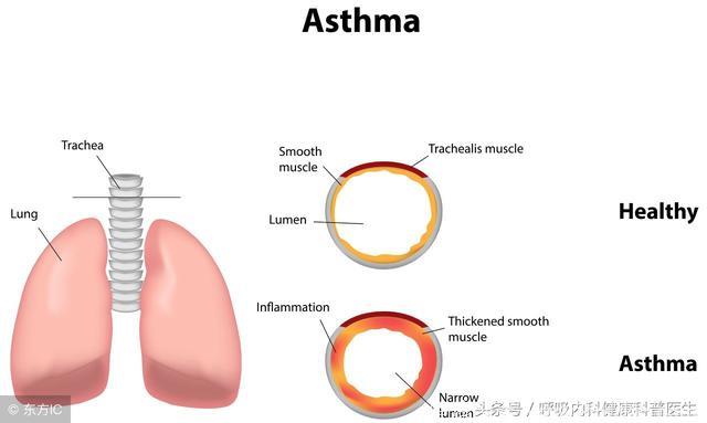 支气管哮喘长期规范药物治疗，90%的哮喘患者可以得到很好控制！