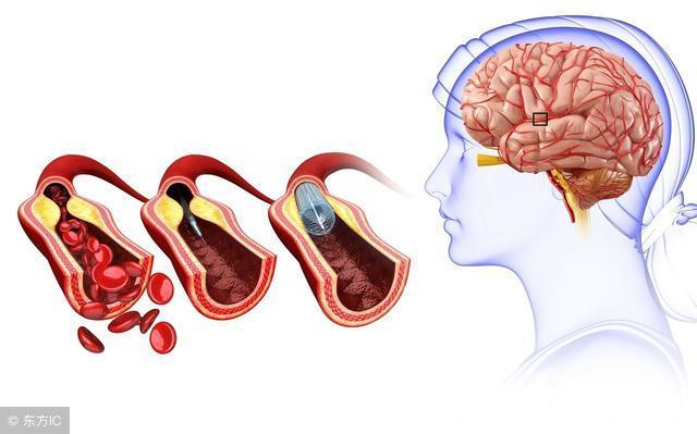 高血压患者头痛的原因有哪些？小心脑中风