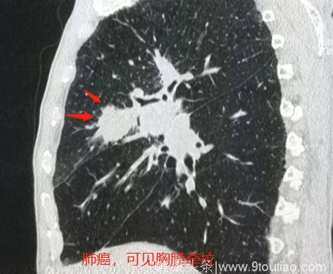为什么有些肺癌转移很快？豪大夫讲肺结节（三）