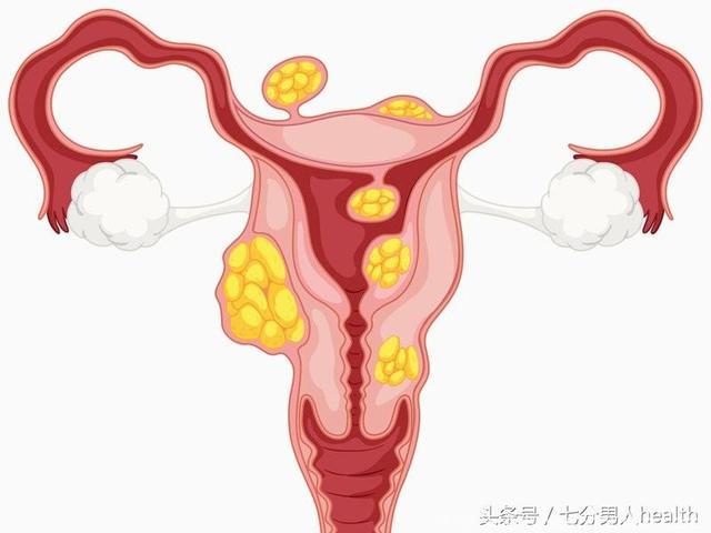 女性怀孕时查出子宫肌瘤，对宝宝有什么影响吗？