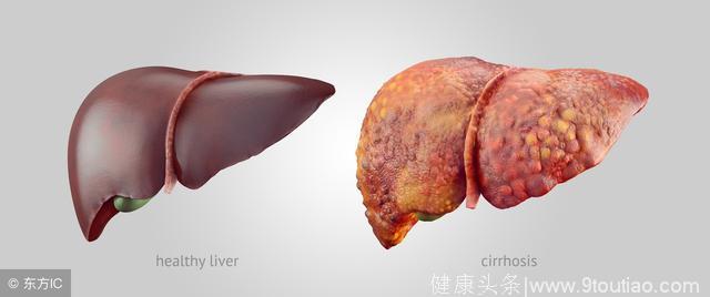 这6种生活表现你还没发现肝脏生病了吗