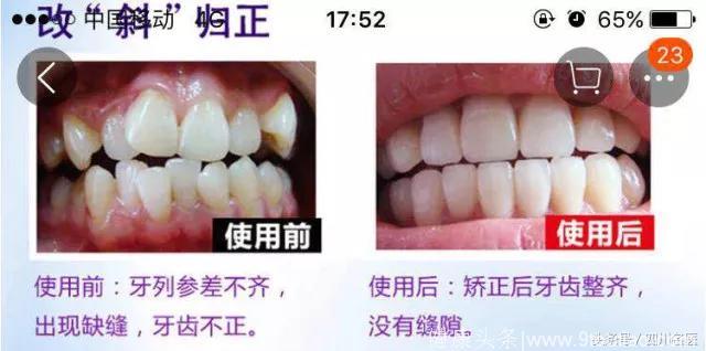 口腔医生揭秘：戴这种牙套，可能会加速牙齿掉落