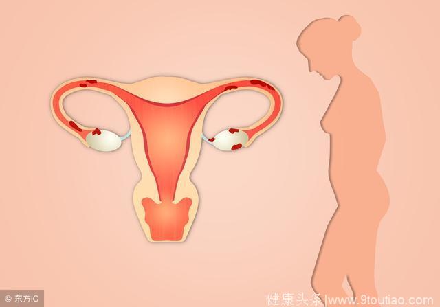 子宫囊肿的临床症状都有什么