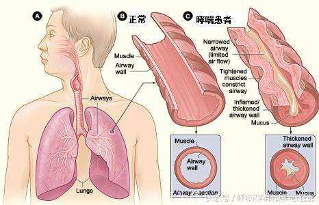 支气管哮喘影响寿命吗，哮喘病人能活多久？