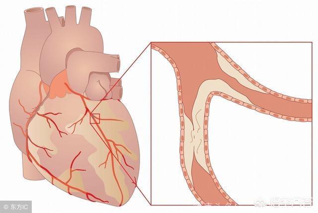 如何判断自己是不是冠心病高危人群？有哪些依据？