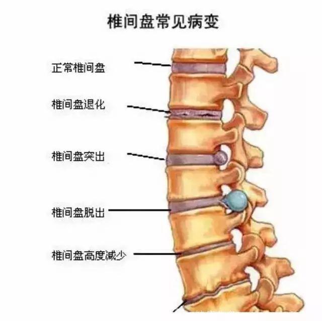 8个瑜伽体式调理腰椎间盘突出！