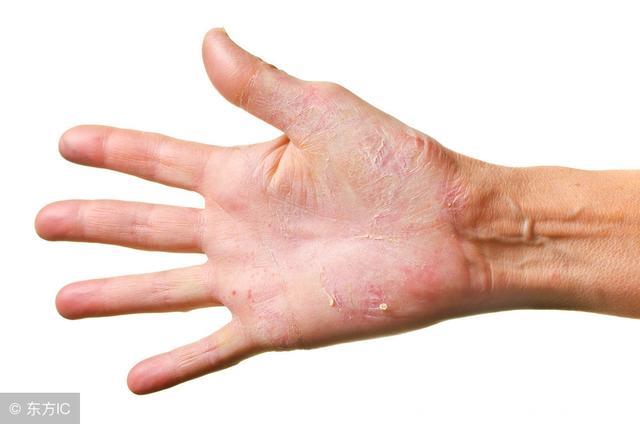夏天皮肤瘙痒？专家帮你分析，避免肝病或肾衰竭！
