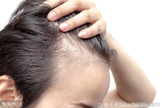 脂溢性皮炎会导致脱发？不想头发掉光光，这4点要注意