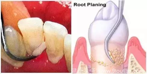 洗牙也分很多种！到底哪种洗牙技术适合你？葉子口腔科普