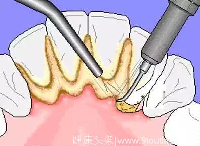 洗牙也分很多种！到底哪种洗牙技术适合你？葉子口腔科普