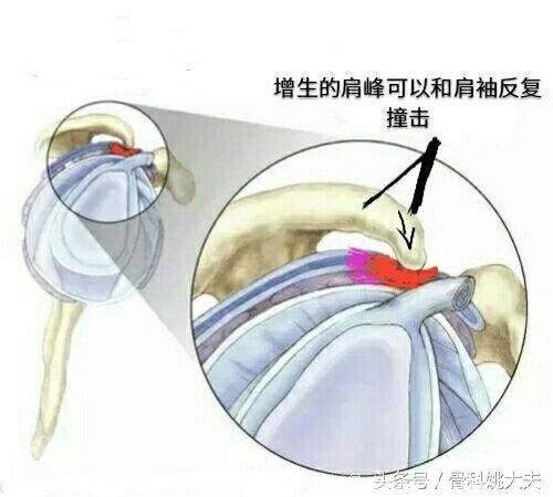 右肩向后伸手时特别疼，会有哪些原因呢？