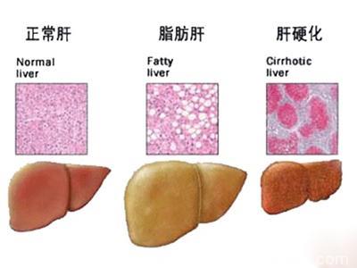 老年人检查出脂肪肝，要对4种食物说“不”，否则会加重病情