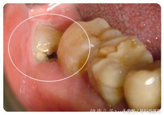 女人备孕期间，为什么一定要去口腔科检查牙齿？