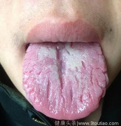 舌头是人体的自查表，出现这6种征兆就要看医生了！