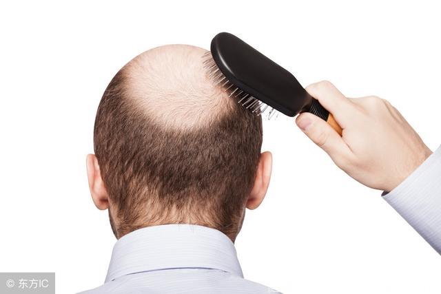 你要不要再挣扎下？目前医学水平阻止男性脱发的5种办法