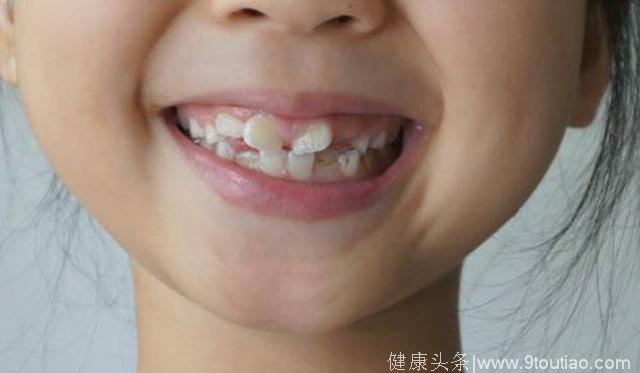 孩子换牙期，一定要及时吃这些食物，避免牙齿长歪，牙齿整齐漂亮