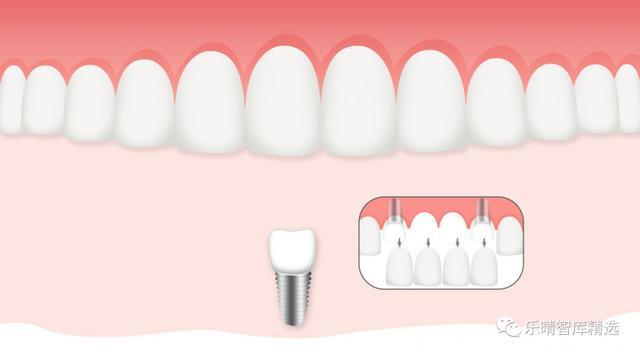 口腔种植牙行业报告：不可“豁”缺的千亿市场