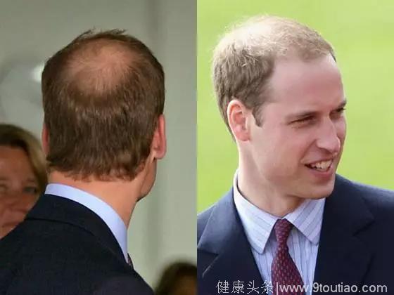防治脱发还得这样？威廉王子请了解一下！