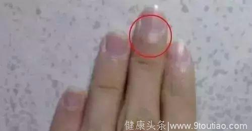 指甲长成这样，竟是癌症的信号？发生这些变化