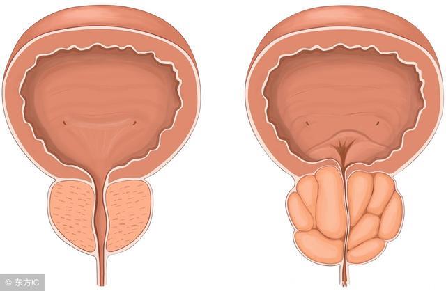 前列腺问题与性生活频繁有关吗？