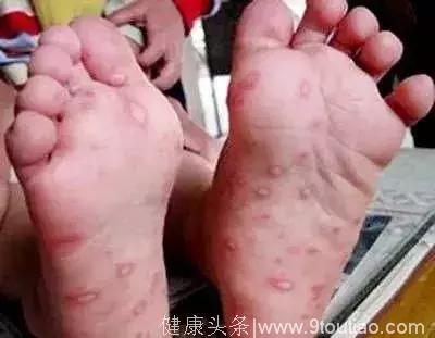哈尔滨疾控中心提醒：这种病进入高发期，疹形区别于往年