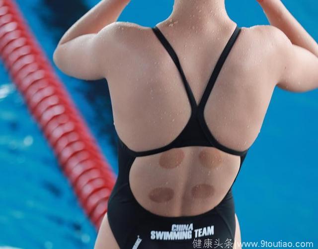 亚运会游泳选手热衷拔罐 中医秘方很流行