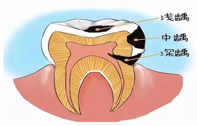 龋齿也是癌症的引路人！一颗“虫牙”这样悄悄伤害你