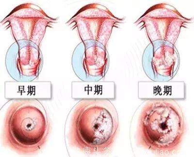 全程真实体验详解：在新加坡做子宫颈癌抹片免费检测