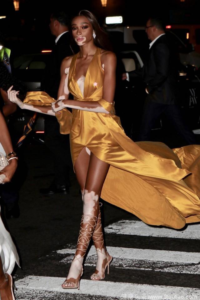 白癜风模特温妮哈洛出席《时尚芭莎》在纽约举行的派对