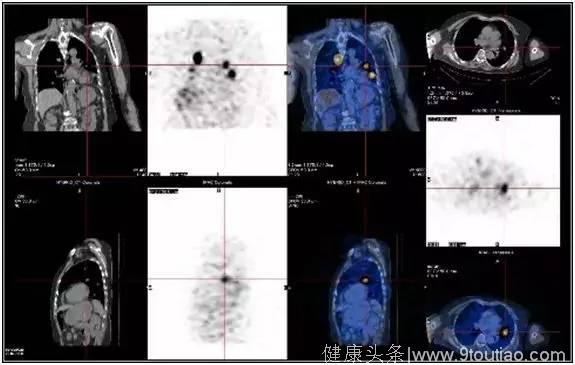 它是“最善良的癌症” 想要战胜它牢记这三步