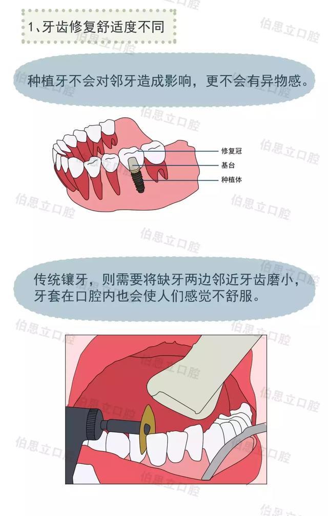 口腔漫画丨种植牙和镶牙哪个好？