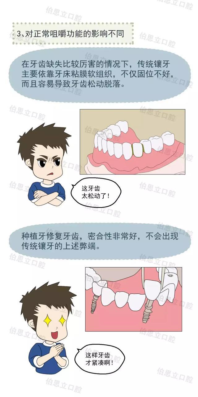口腔漫画丨种植牙和镶牙哪个好？