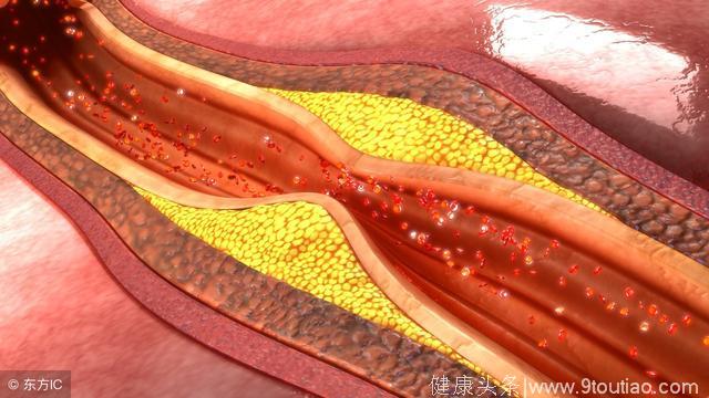 心血管王医生告诉您：能把血管内的斑块消除吗？