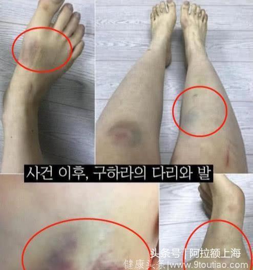 韩女星被男友打到子宫出血，主动求和被拒，可能面临判刑