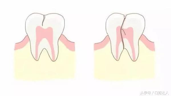 牙齿“节后综合症”，你中招了吗？