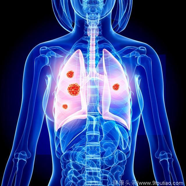 “普利类”降压药可能增加肺癌风险