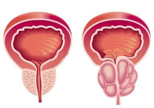 前列腺增生能治好吗？男人如何保护自己的前列腺？