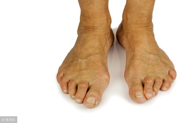 不论男女，脚上若有这3种异常，警惕癌细胞，坚持2件事远离癌症