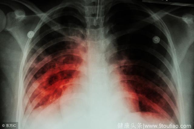 肺结核的全身症状与哮喘、支气管炎有何区别