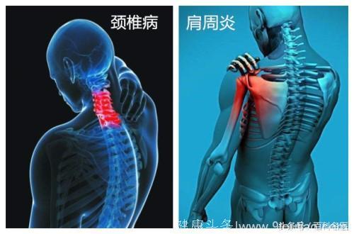 颈椎病和肩周炎你分得清吗？专家6招教你辨别颈椎病和肩周炎！
