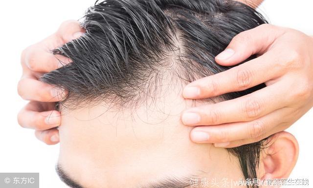 脂溢性脱发怎么治疗？多管齐下，还能拯救你的头发
