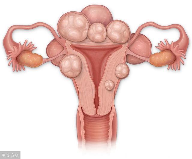 怎样自己排查子宫肌瘤？哪些因素会导致女性长子宫肌瘤呢
