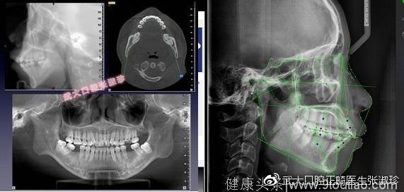 正畸方案制定为什么一定要先拍牙片？